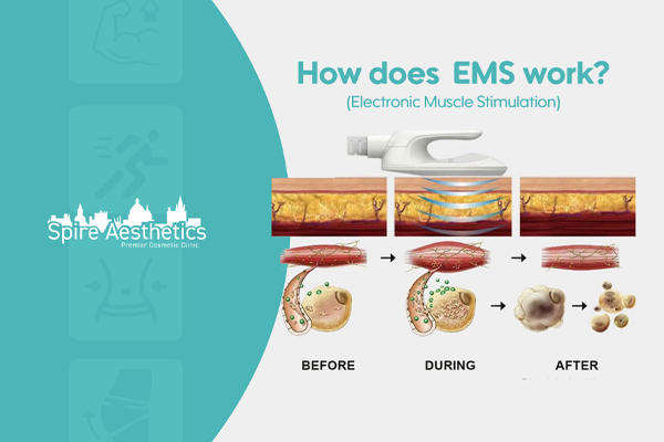 EMS treatment for post pregnancy weight loss treatment Hucknall