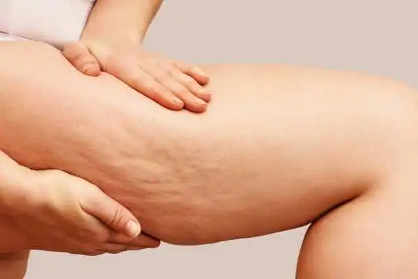 Image of woman showing leg with cellulite Hucknall