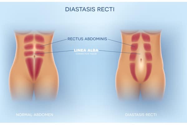 What Non-Surgical Options Are Available for Diastasis Recti Hucknall?