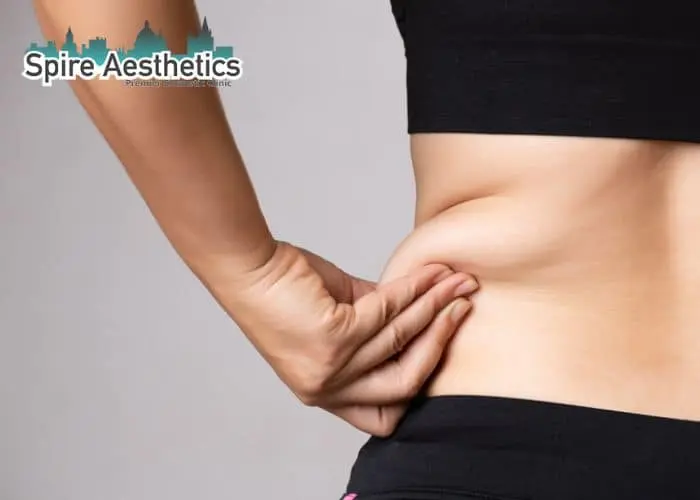 Image of woman pinching fat on their hips Hucknall. Fat Freezing treatment