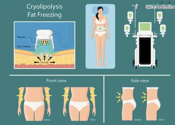 Fat freezing treatment Hucknall benefits for competitions to remove stubborn fat deposits.