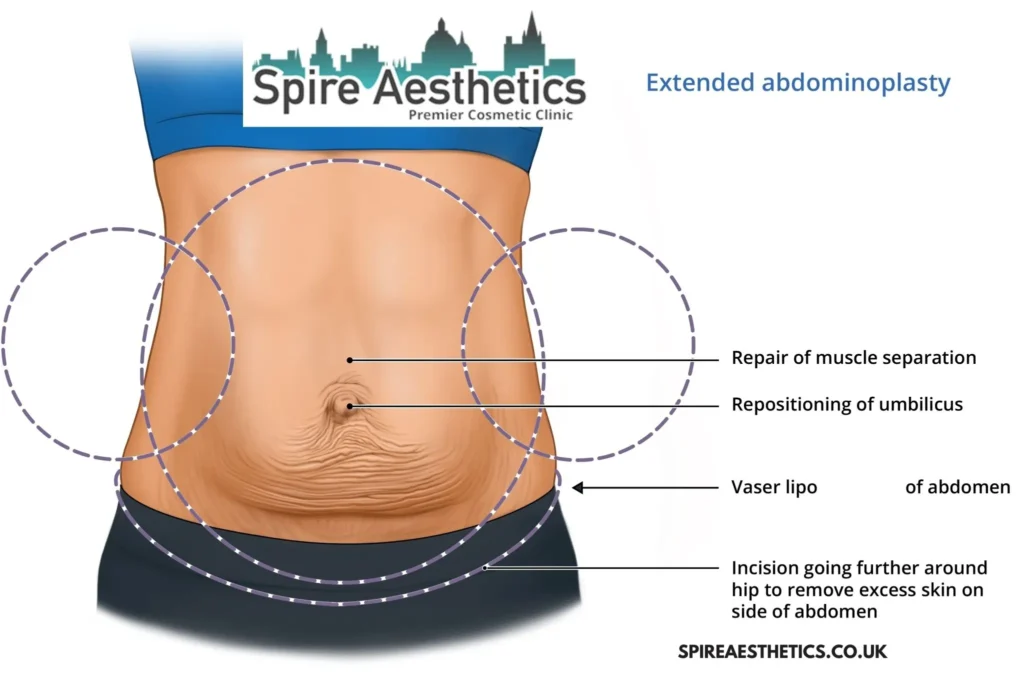 Understanding Loose Skin After Gastric Band Hucknall Surgery and HIFU Treatment