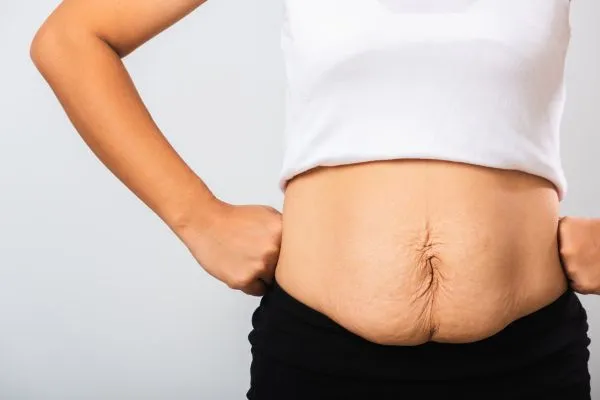 Image of a woman's stomach after weight loss with sagging skin following a gastric band Hucknall