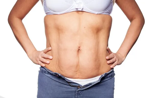 sagging skin on woman's stomach after weight loss injections Hucknall