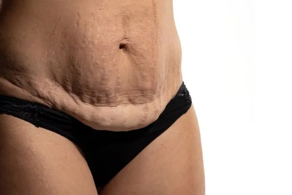 Image of womans stomach after weight loss injections Hucknall showing saggy skin