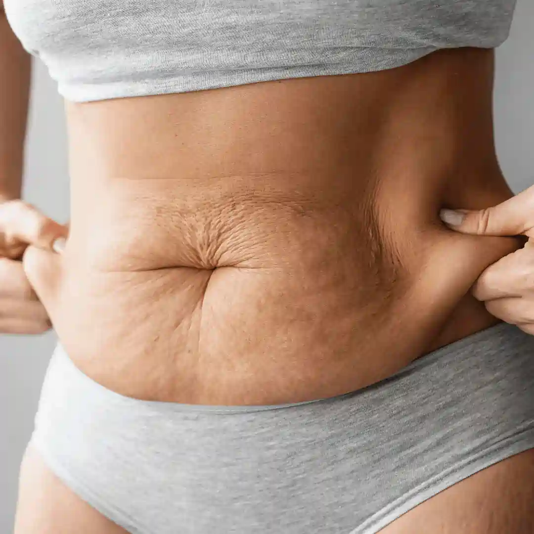 Is It Normal to Have Loose Skin After Pregnancy Hucknall?