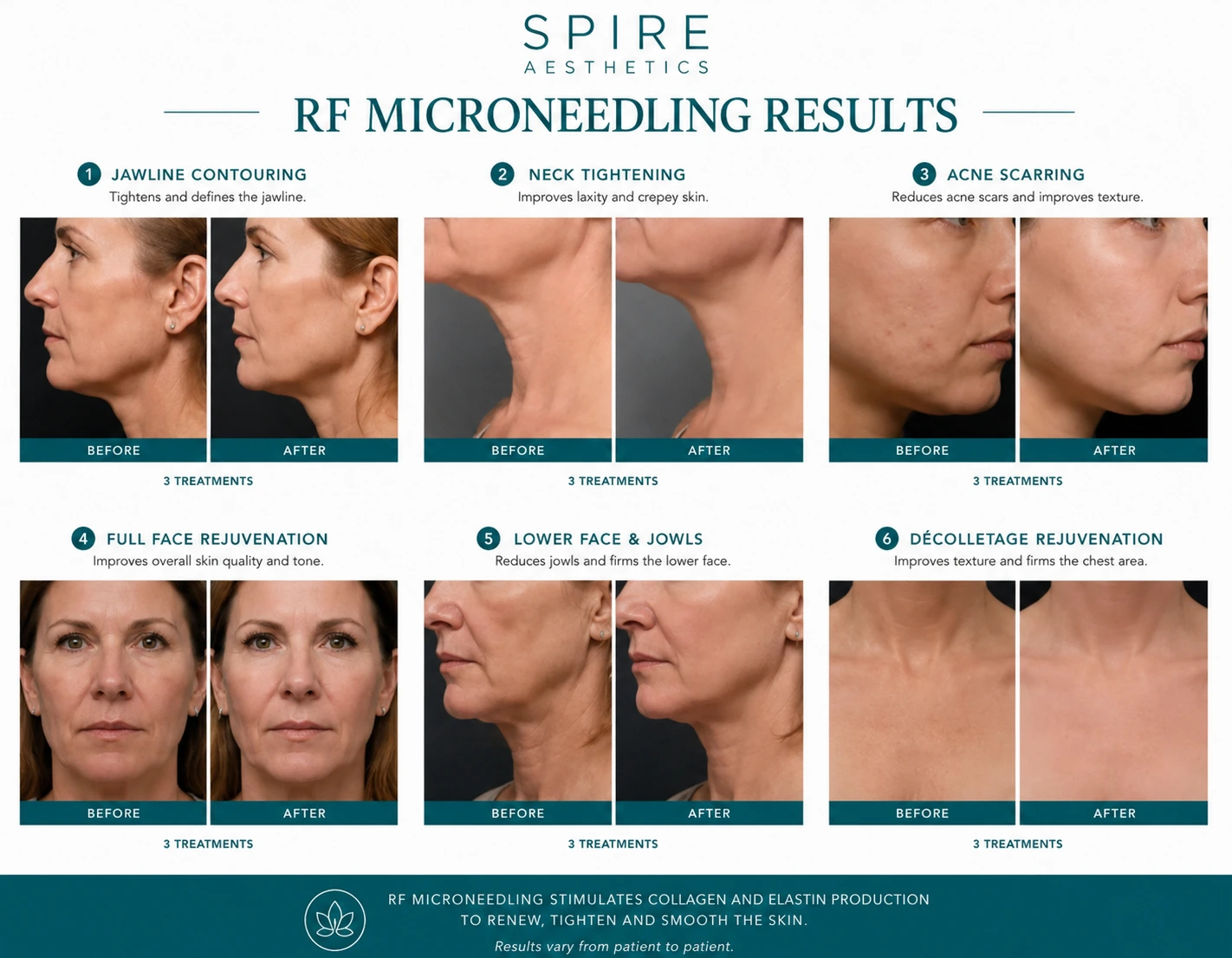 RF Microneedling Skin tightening Hucknall results
