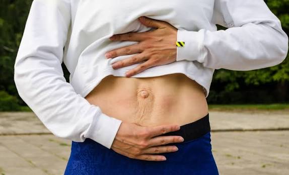 When Could Diastasis Recti Be the Missing Piece of the Puzzle Hucknall?