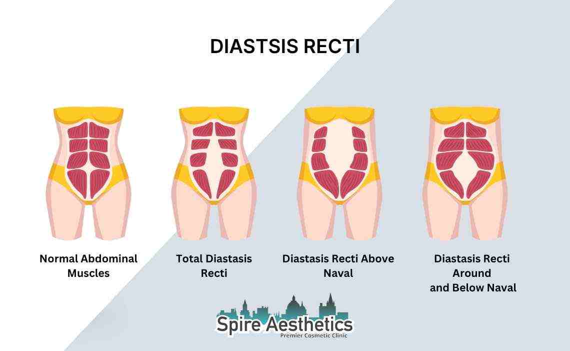 Is Non-Surgical Diastasis Recti Treatment Right for You? Common Concerns Answered Hucknall